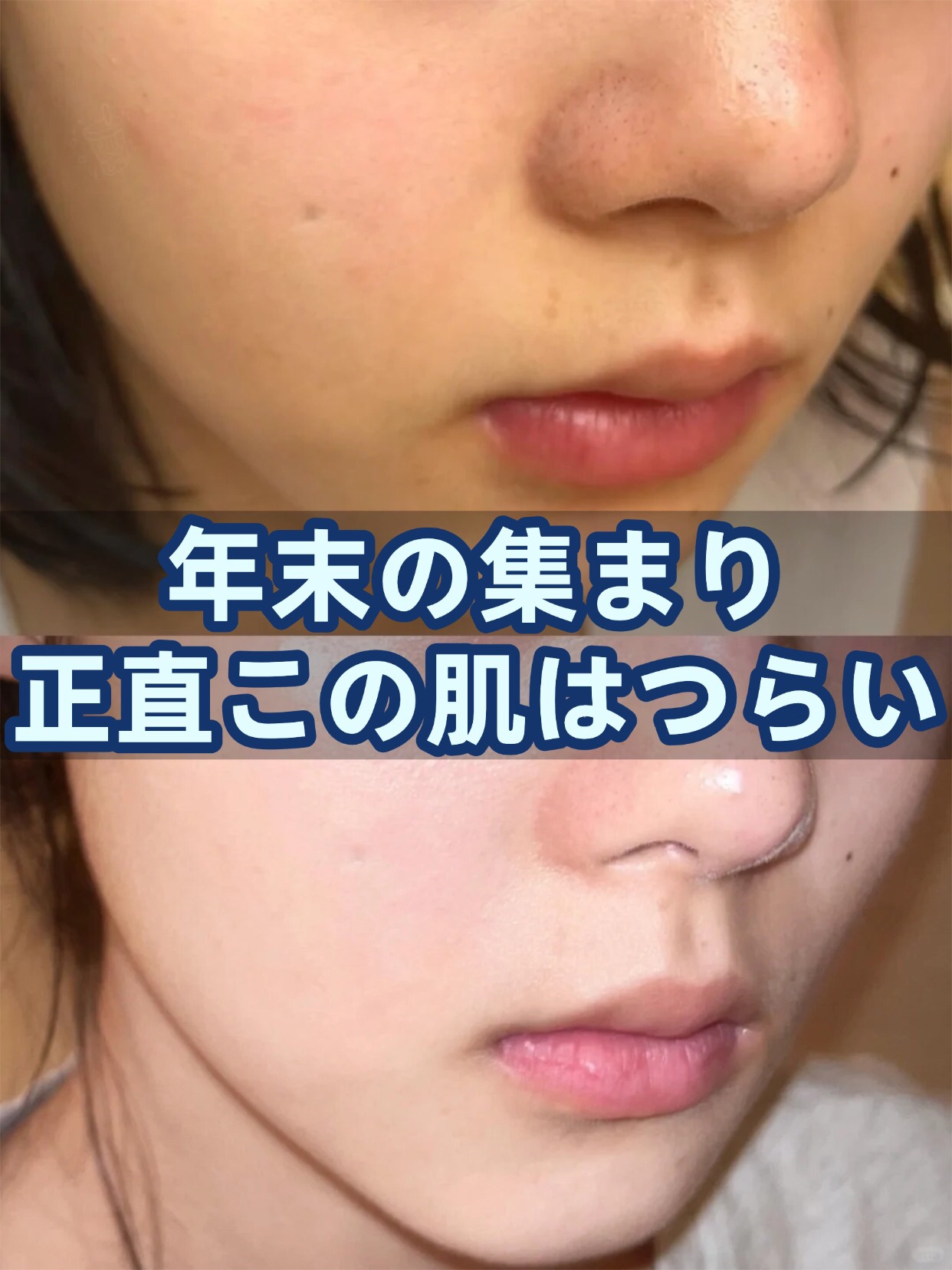 アネトス アクネケア トリートメント セラム/Anetos/美容液を使ったクチコミ（1枚目）