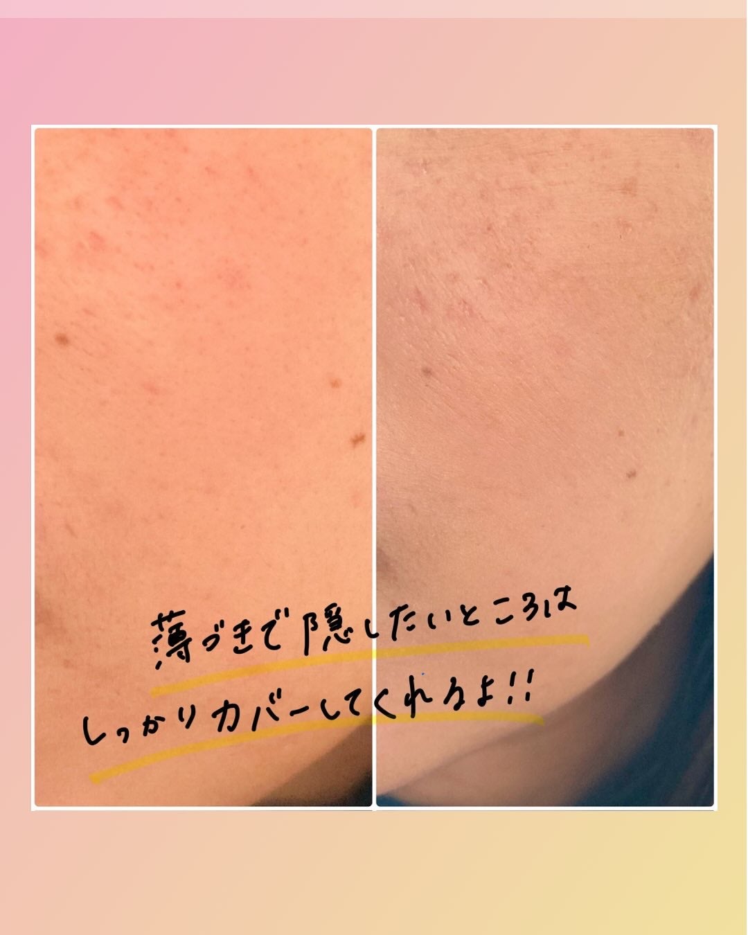 モイストラボ ハイカバー薬用美白BBクリーム/Moist Labo/BBクリームを使ったクチコミ(5枚目)