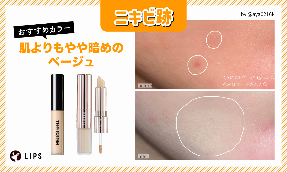 ニキビ跡におすすめのカラーは、肌よりもやや暗めのベージュ。