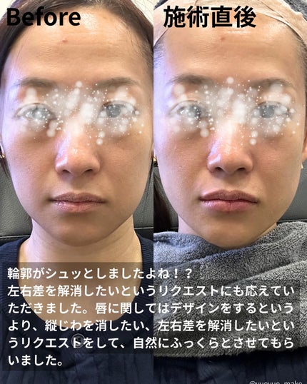 YUEMI on LIPS 「【PR】TheiAクリニック様ご提供今回の渡韓で糸リフトと唇フ..」(4枚目)