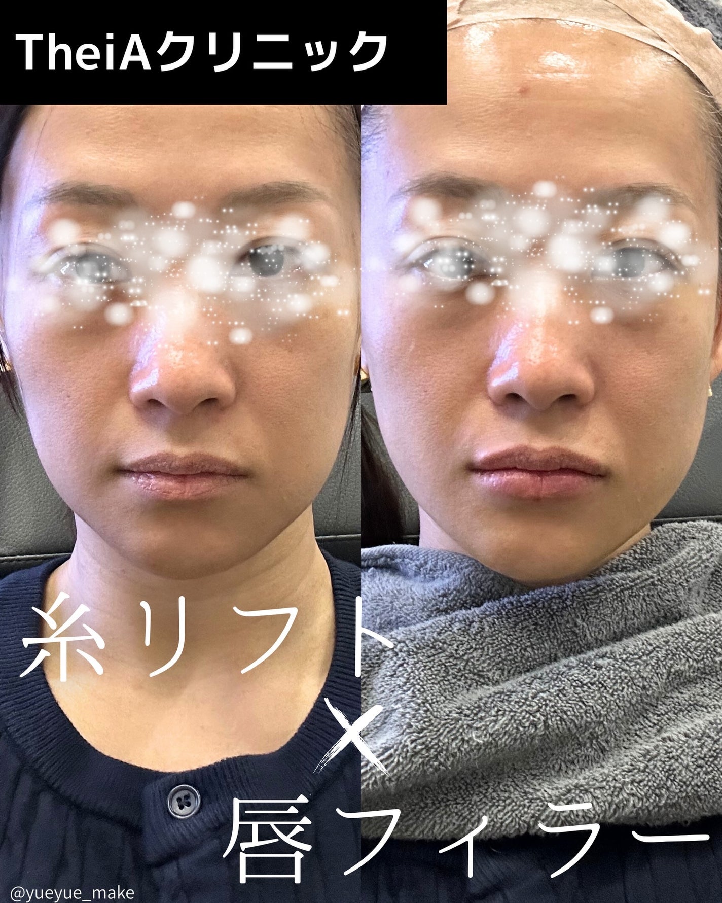 YUEMI on LIPS 「【PR】TheiAクリニック様ご提供今回の渡韓で糸リフトと唇フ..」(1枚目)