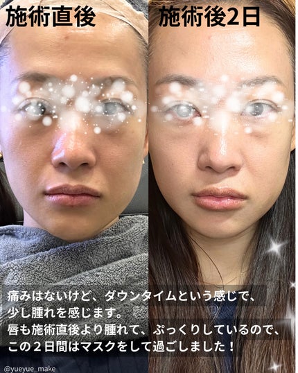 YUEMI on LIPS 「【PR】TheiAクリニック様ご提供今回の渡韓で糸リフトと唇フ..」(5枚目)