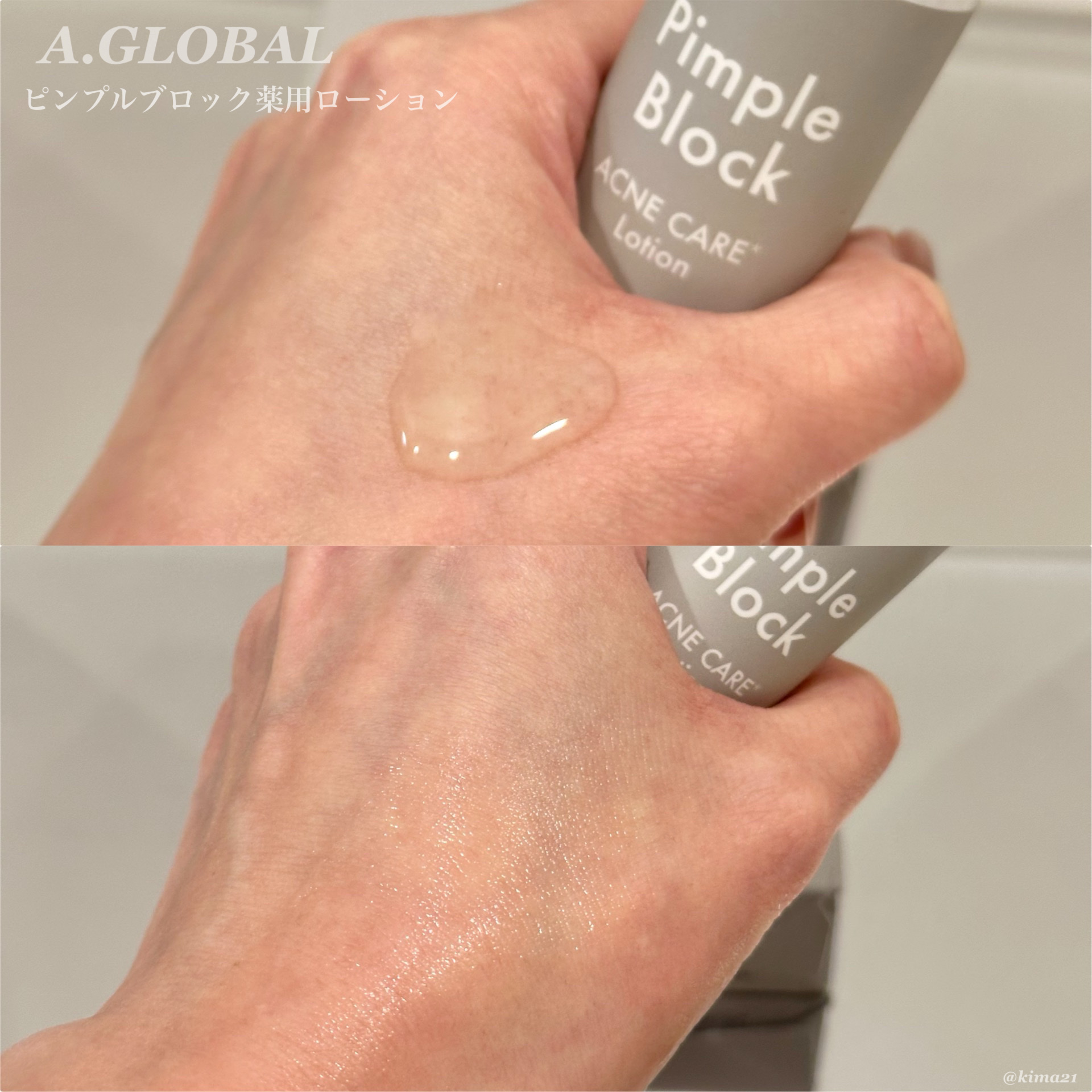 Pimple Block ピンプルブロック アクネ洗顔（医薬部外品）のクチコミ「#PR 

A.GLOBAL
Pimple Block(ピンプルブロック)
※トライアルセット.....」（2枚目）