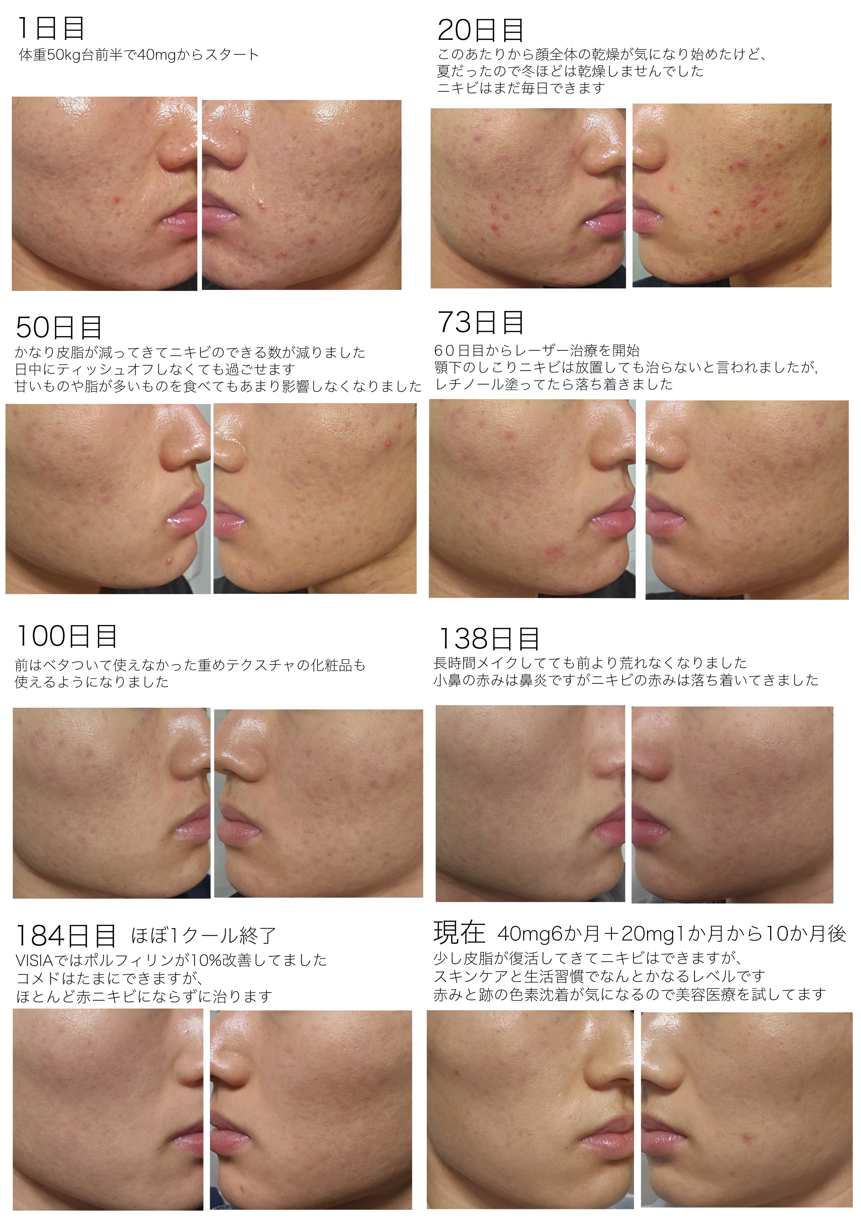 スキンピールバー ティートゥリー/サンソリット/洗顔石鹸を使ったクチコミ（3枚目）