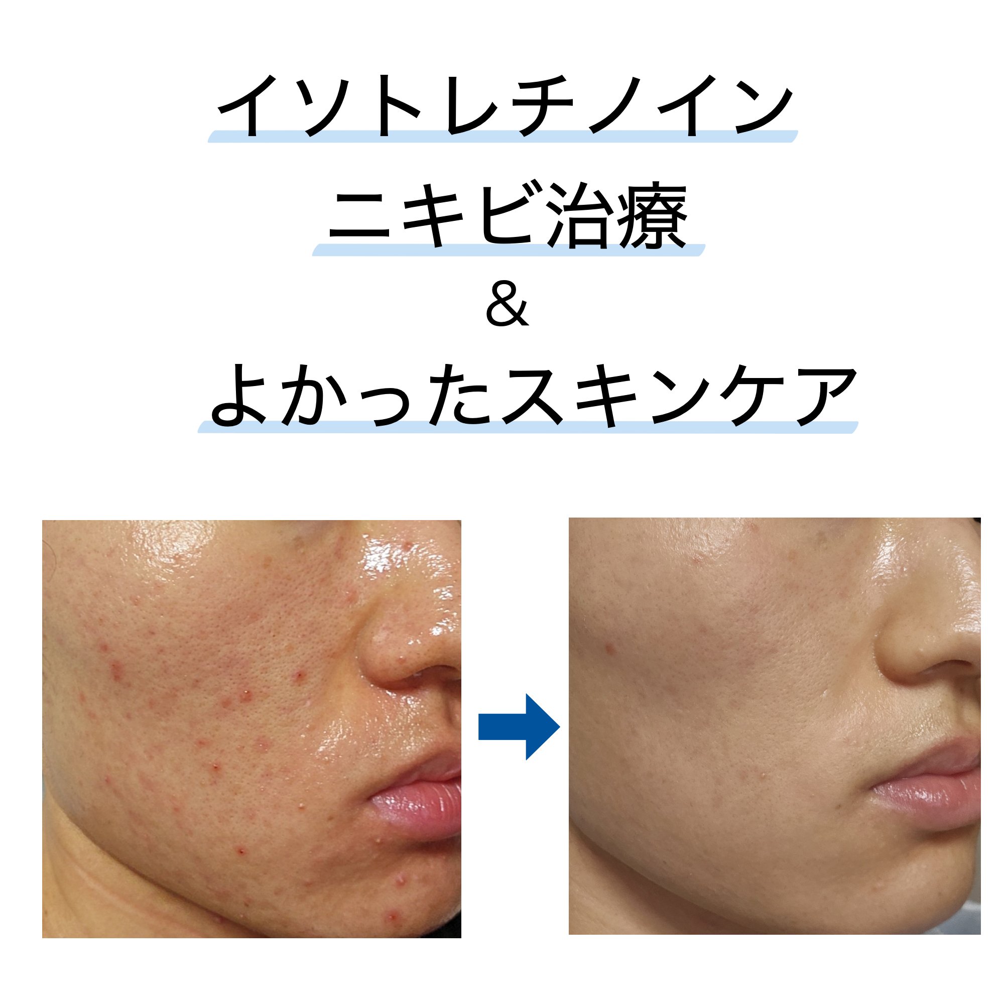 スキンピールバー ティートゥリー/サンソリット/洗顔石鹸を使ったクチコミ（1枚目）