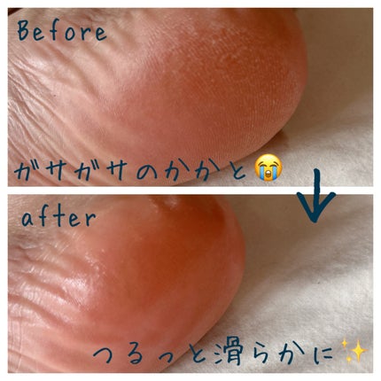 Cracked Heelクリーム/COCOCARE/レッグ・フットケアを使ったクチコミ(5枚目)