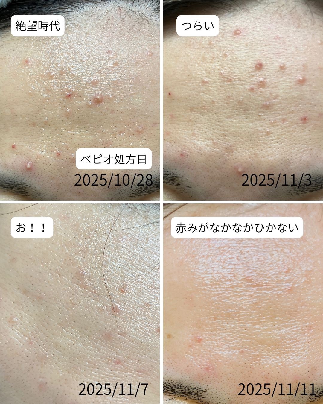 鼻セレブ 洗顔専用/ネピア/クレンジングタオルを使ったクチコミ(10枚目)