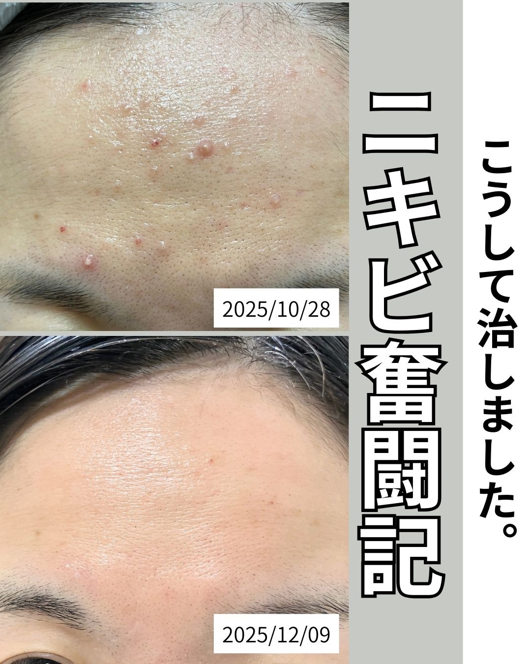 【実録】全滅！おでこニキビを治した6つの習慣｜
皮膚科の薬＆正しい洗顔で肌質改善✨


皮膚科での稗粒腫ケアをきっかけに、
なぜかおでこニキビが爆誕…💥 

今までこんなに荒れたことがなくて、
鏡を見るたびに正直かなり凹んでいました。

