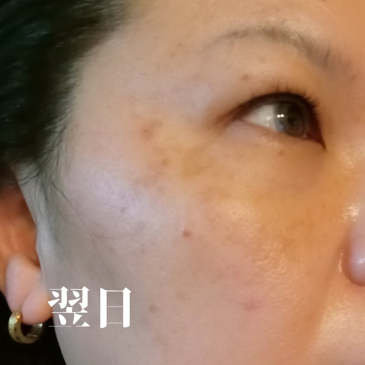 ビヨンセ奥二重向上委員長🥸LIPSパートナー🥳 on LIPS 「【つばきスキンクリニック】青葉台に12月に新しくできたクリニッ..」(6枚目)