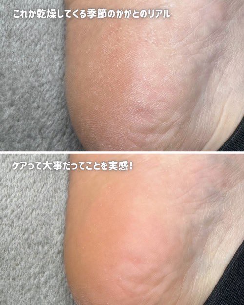 フットケアセット/BAREN/その他キットセットを使ったクチコミ（3枚目）