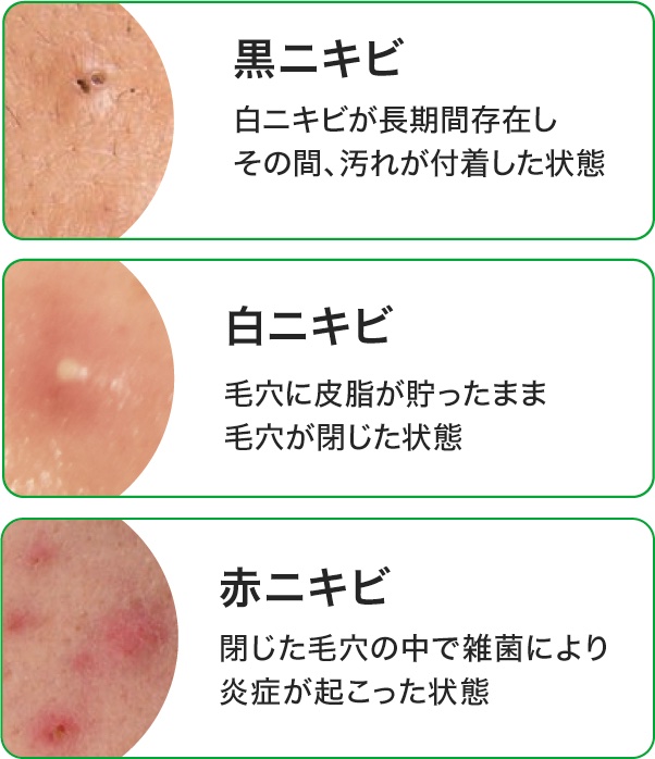 プロCICA クリアスポットパッチ 96枚/VT/その他スキンケアを使ったクチコミ（1枚目）