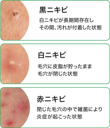 プロCICA クリアスポットパッチ 96枚/VT/その他スキンケアを使ったクチコミ(1枚目)