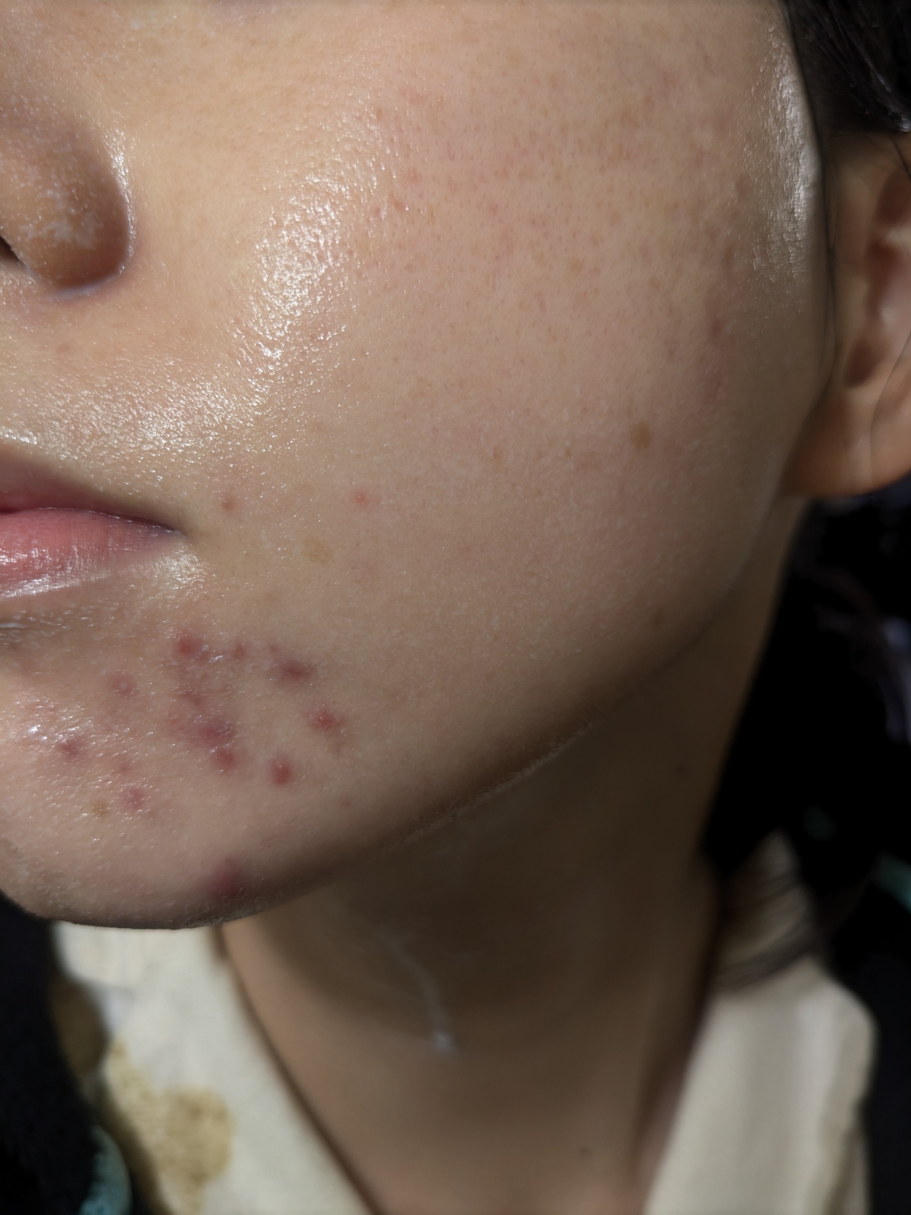 2025/1/2の#汚肌工事録

1年前、めっちゃ荒れてる😂😂😂😂