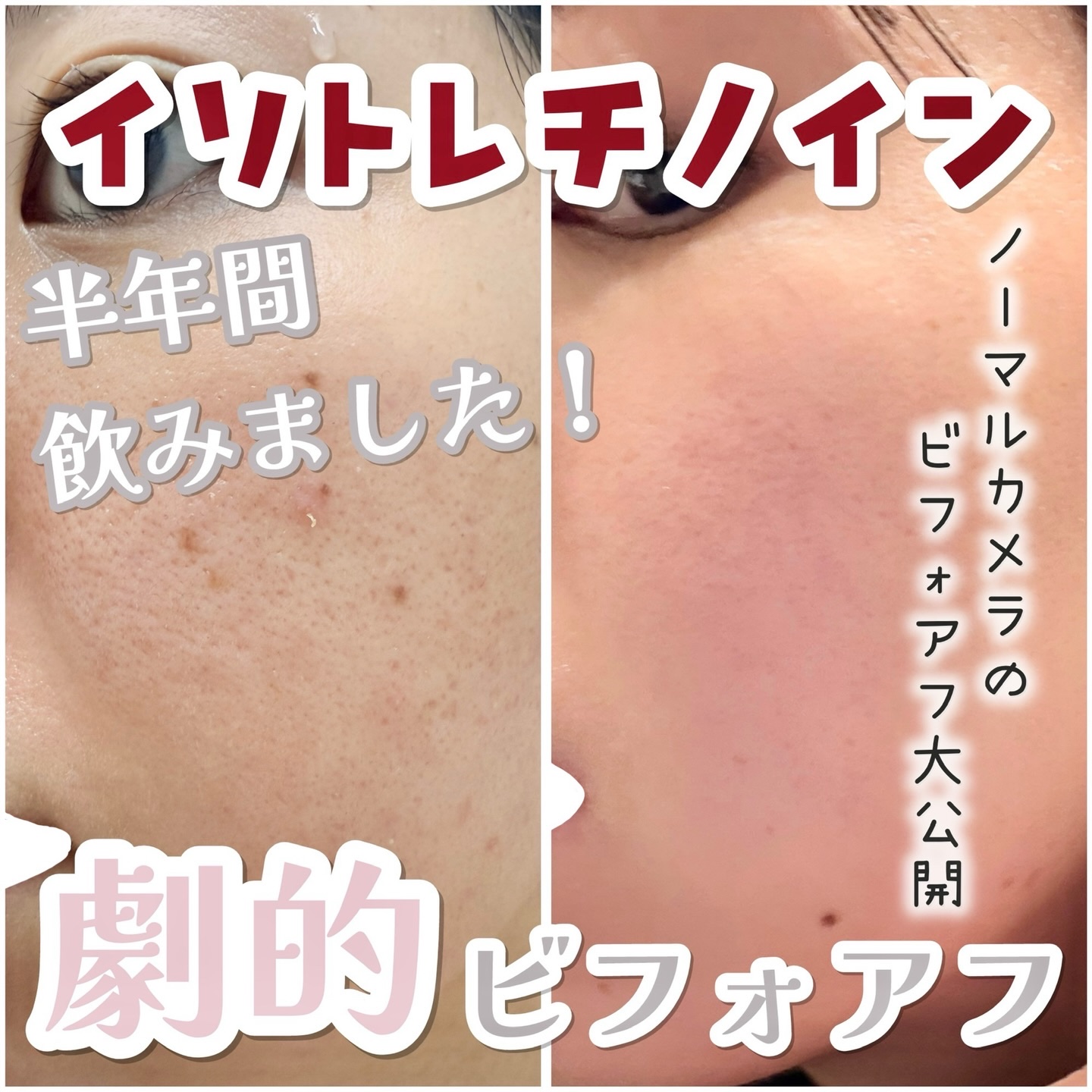 今年のベストコスメ(？)はイソトレチノインです。

自然豊かな八王子から渋谷に引っ越したら、肌荒れが止まらなくなり、
ついにイソトレチノインに手を出してみました。
1ヶ月目、2ヶ月目、さらに半年後と3回血液検査をするから
やっぱり慎重に飲む