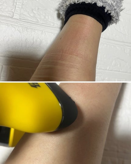 3 in 1脱毛器 (ボディ用脱毛器)/PURPLE GORILLA/家庭用脱毛器を使ったクチコミ(5枚目)