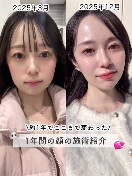 tobibi on LIPS 「約1年でここまで変わった/1年間の顔の施術まとめ約1年間の間に..」(1枚目)