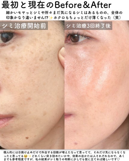 まや|-5歳見えを叶える美容note on LIPS 「⋆⸜₊̣̇.𓈒𓏸シミ取り放題リアルレポ𓏸𓈒.₊̣̇⸝⋆はじめに..」(7枚目)