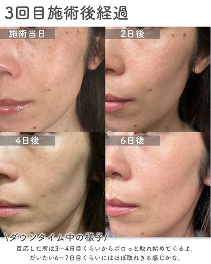 まや|-5歳見えを叶える美容note on LIPS 「⋆⸜₊̣̇.𓈒𓏸シミ取り放題リアルレポ𓏸𓈒.₊̣̇⸝⋆はじめに..」(6枚目)