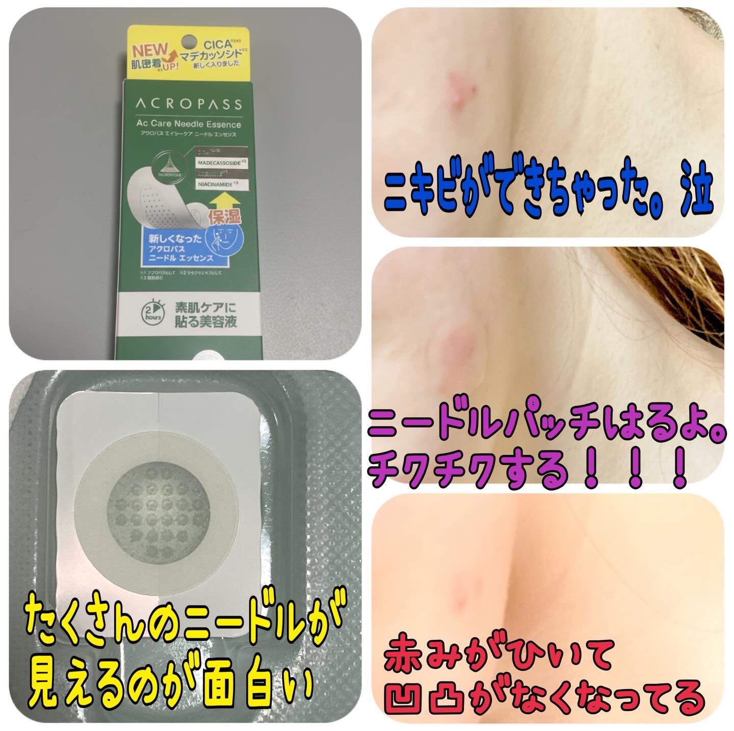 エイシーケアNE/ACROPASS/その他スキンケアを使ったクチコミ（2枚目）