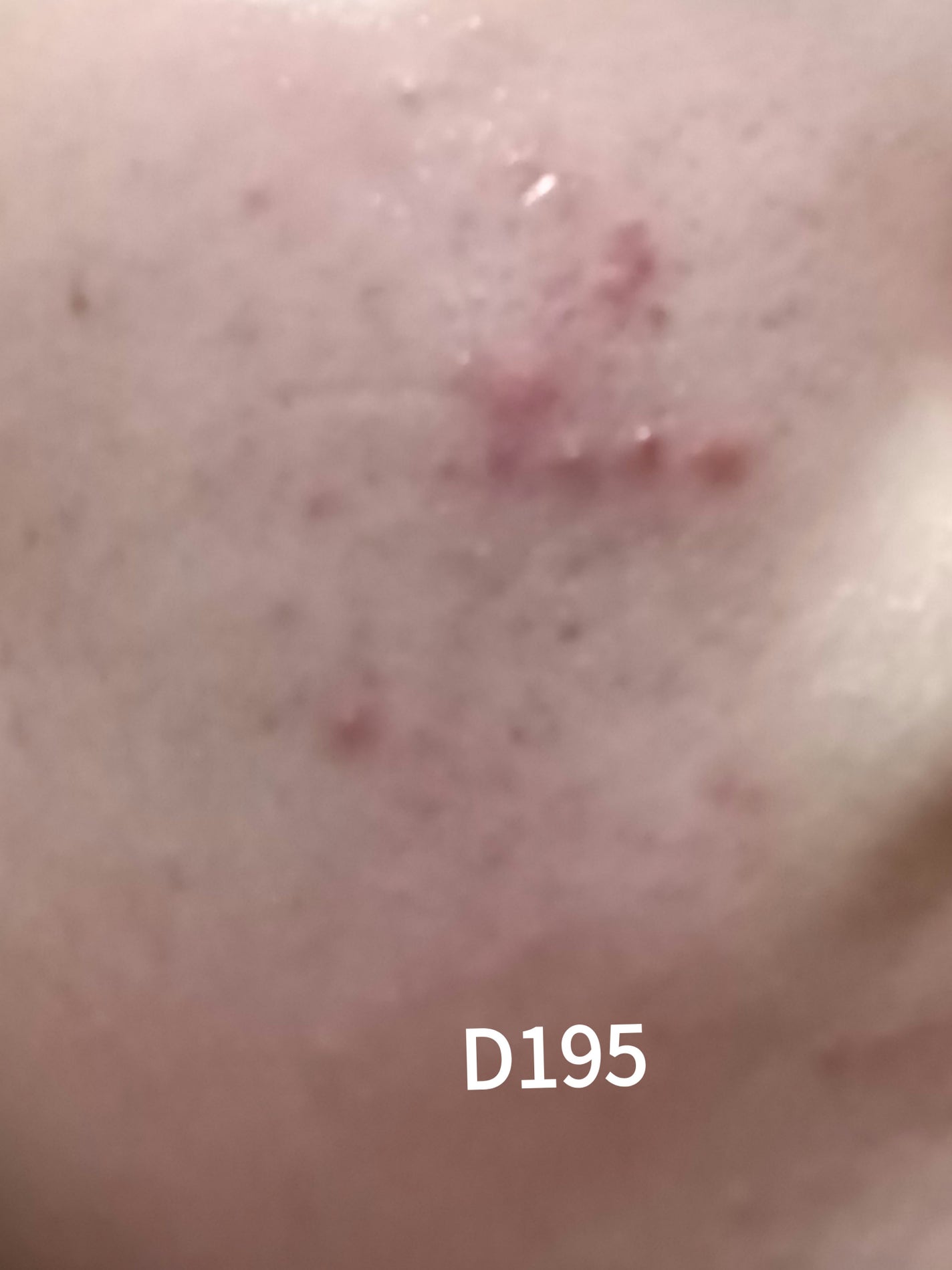 いぬ✢フォロバ100✢ on LIPS 「ニキビ記録195日目荒れてるし赤みもエグい、赤みぱっと見わかん..」(1枚目)