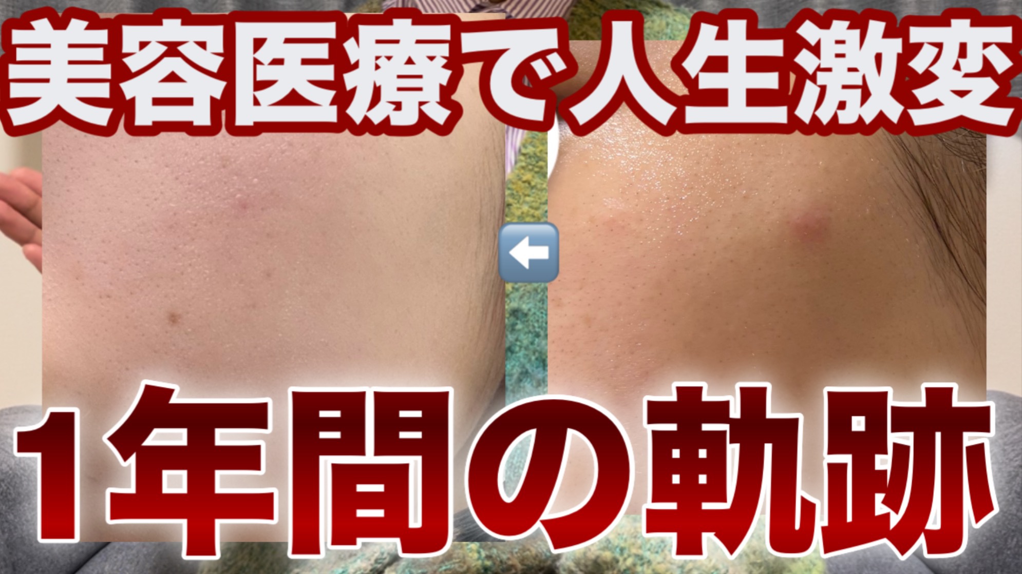 今週のYouTubeはコチラ✩.*˚

#美容医療 #美容皮膚科 #インナードライ #黒ずみ毛穴 #ニキビ