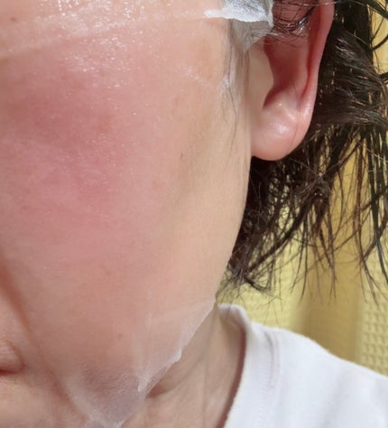 植物性ボトックスマスクパック/CHICSKIN/シートマスク・パックを使ったクチコミ(6枚目)