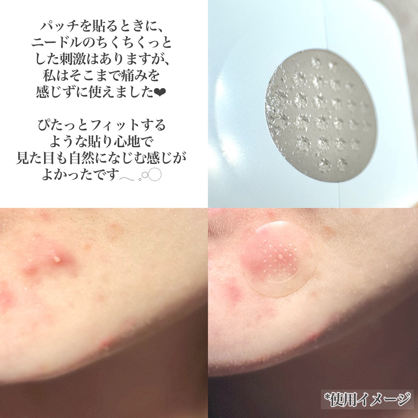 エイシーケアNE/ACROPASS/その他スキンケアを使ったクチコミ(4枚目)