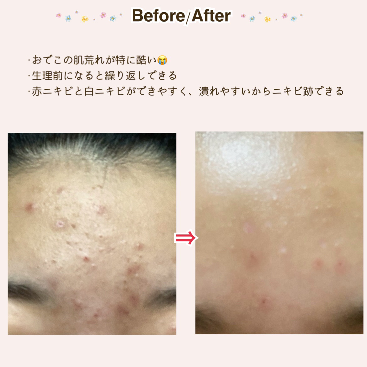 ヒアルロン酸原液/太陽のアロエ社/美容液を使ったクチコミ（3枚目）