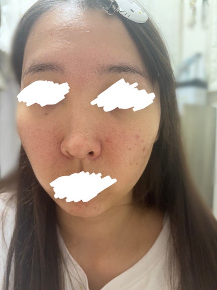 ピールソープ AHA/プラスキレイ/洗顔石鹸を使ったクチコミ(2枚目)