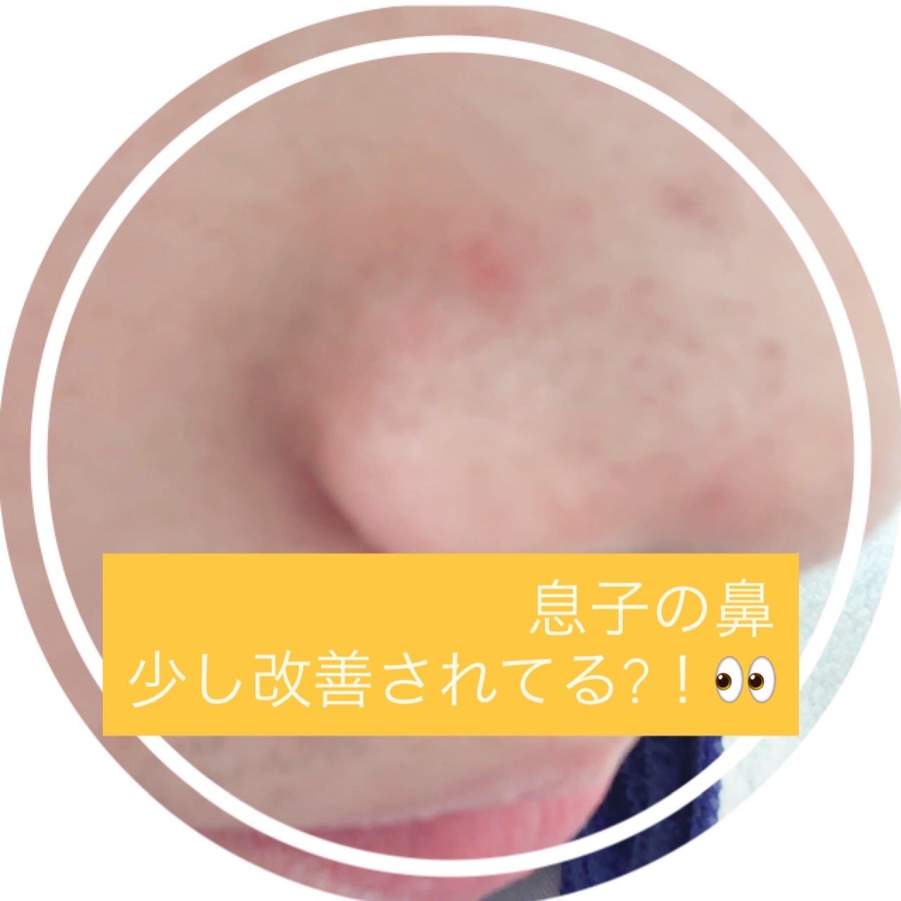 エイシーケアNE/ACROPASS/その他スキンケアを使ったクチコミ(4枚目)