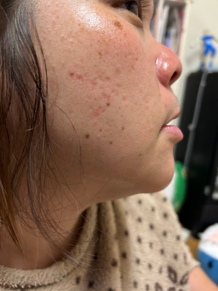 クラウドアンプル 1week キット/CHARDE/美容液を使ったクチコミ(1枚目)