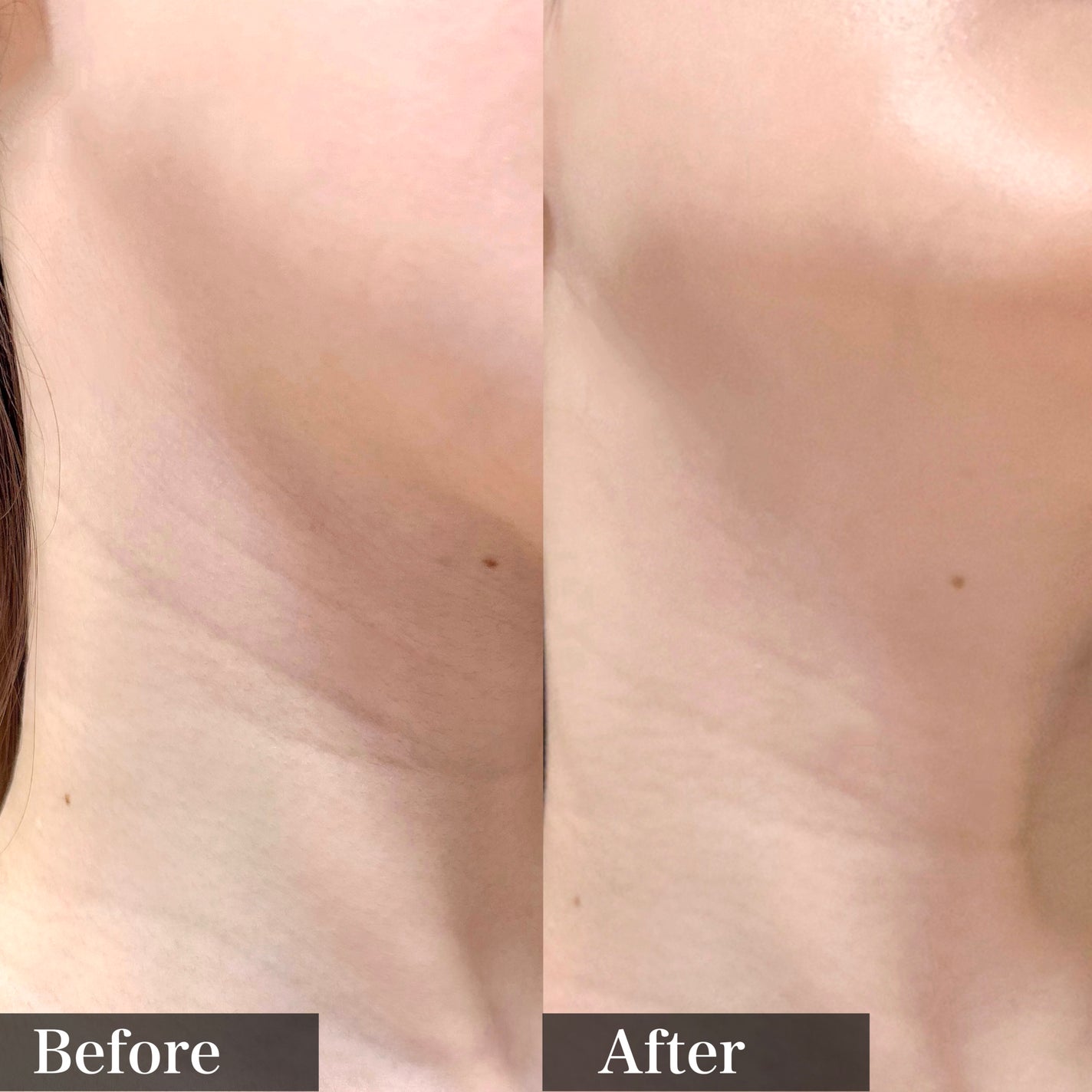 プレミアムペプチドナイテ1000ショットネックスティック/MEDIPEEL/ネック・デコルテケアを使ったクチコミ(3枚目)