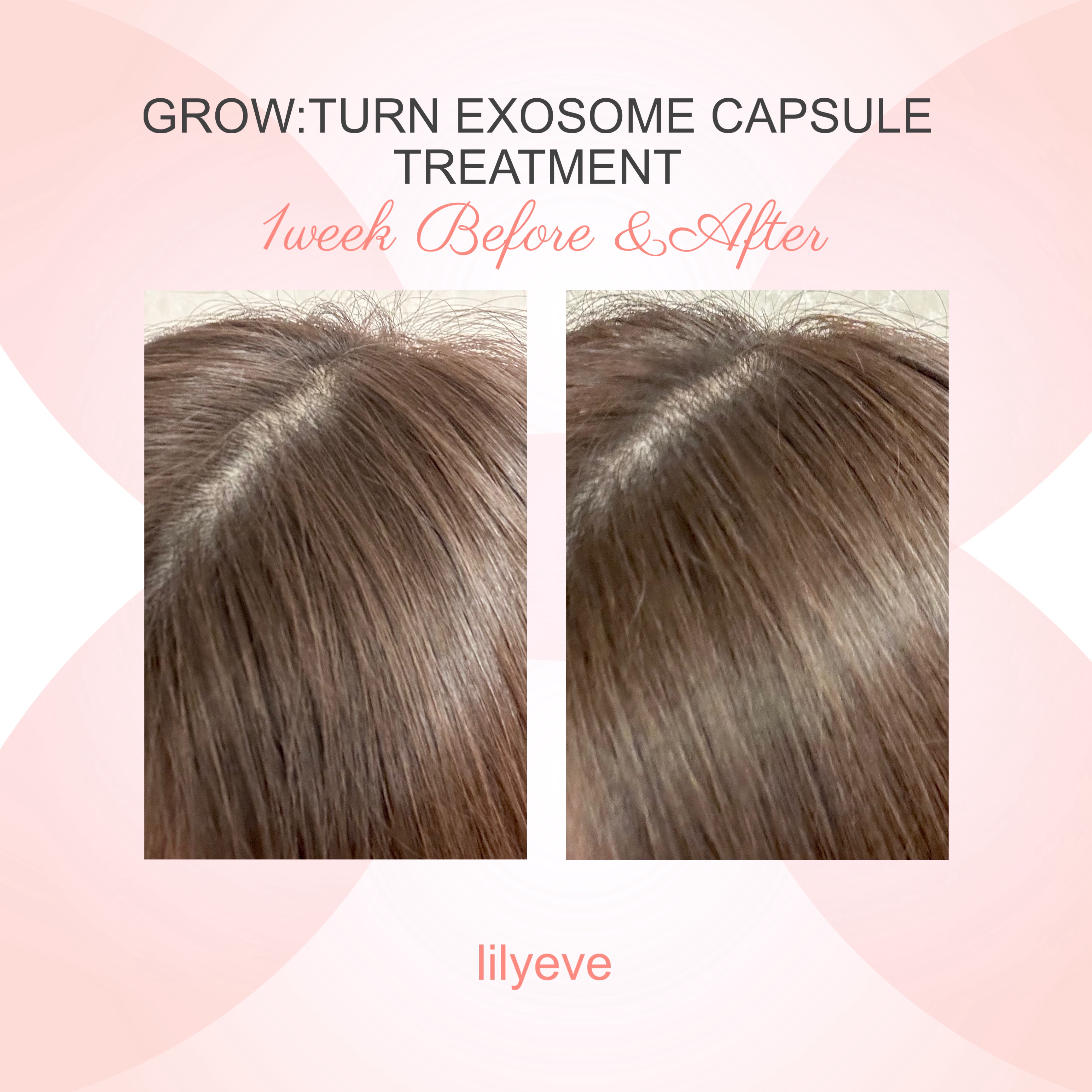 グローターン エクソソーム カプセル トリートメン/リリーイブ/洗い流すヘアトリートメントを使ったクチコミ（2枚目）