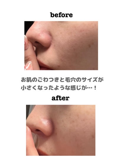 スワン✧*。 on LIPS 「セロラバイペンタショットセロラバイは、クリニック発想の毛穴ケア..」(6枚目)