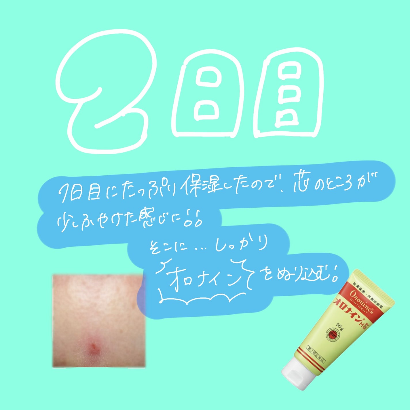 オロナインH軟膏 (医薬品)/オロナイン/その他を使ったクチコミ(3枚目)