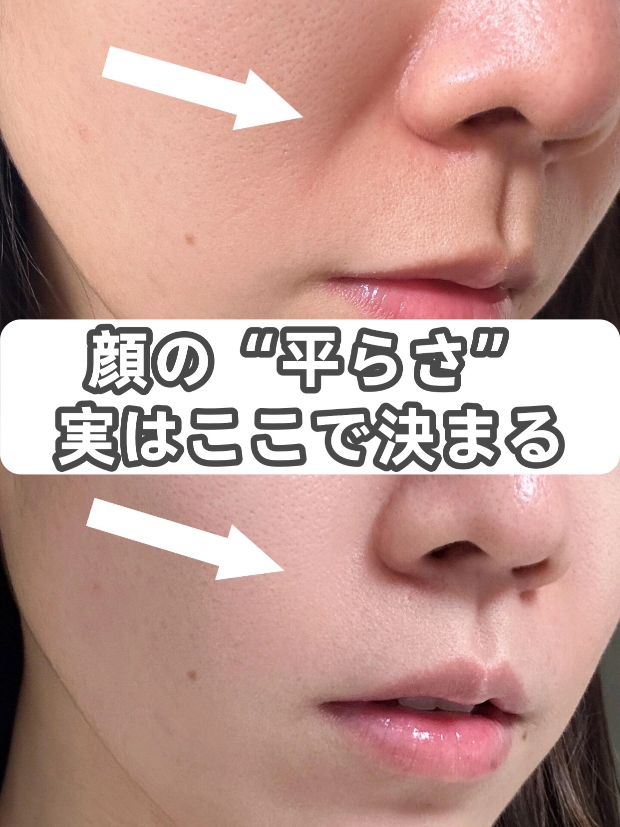 アネトス アクネケア トリートメント セラム/Anetos/美容液を使ったクチコミ（1枚目）