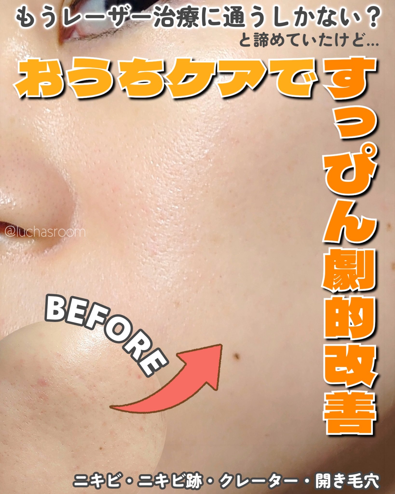 中学生のころからニキビができやすく、大人になっても
それは変わらず…
そのせいでニキビ跡、クレーター、開き毛穴も多発…

茶色いニキビ跡はメイクで隠せるけど、赤いニキビ跡は
隠せないし…凹凸はむしろメイクした方が目立つのが
最大の悩みでした