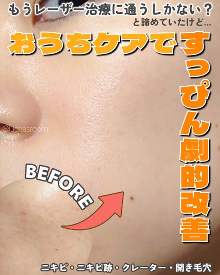 トリア・スキン エイジングケアレーザー/トリア/美顔器・マッサージを使ったクチコミ(1枚目)