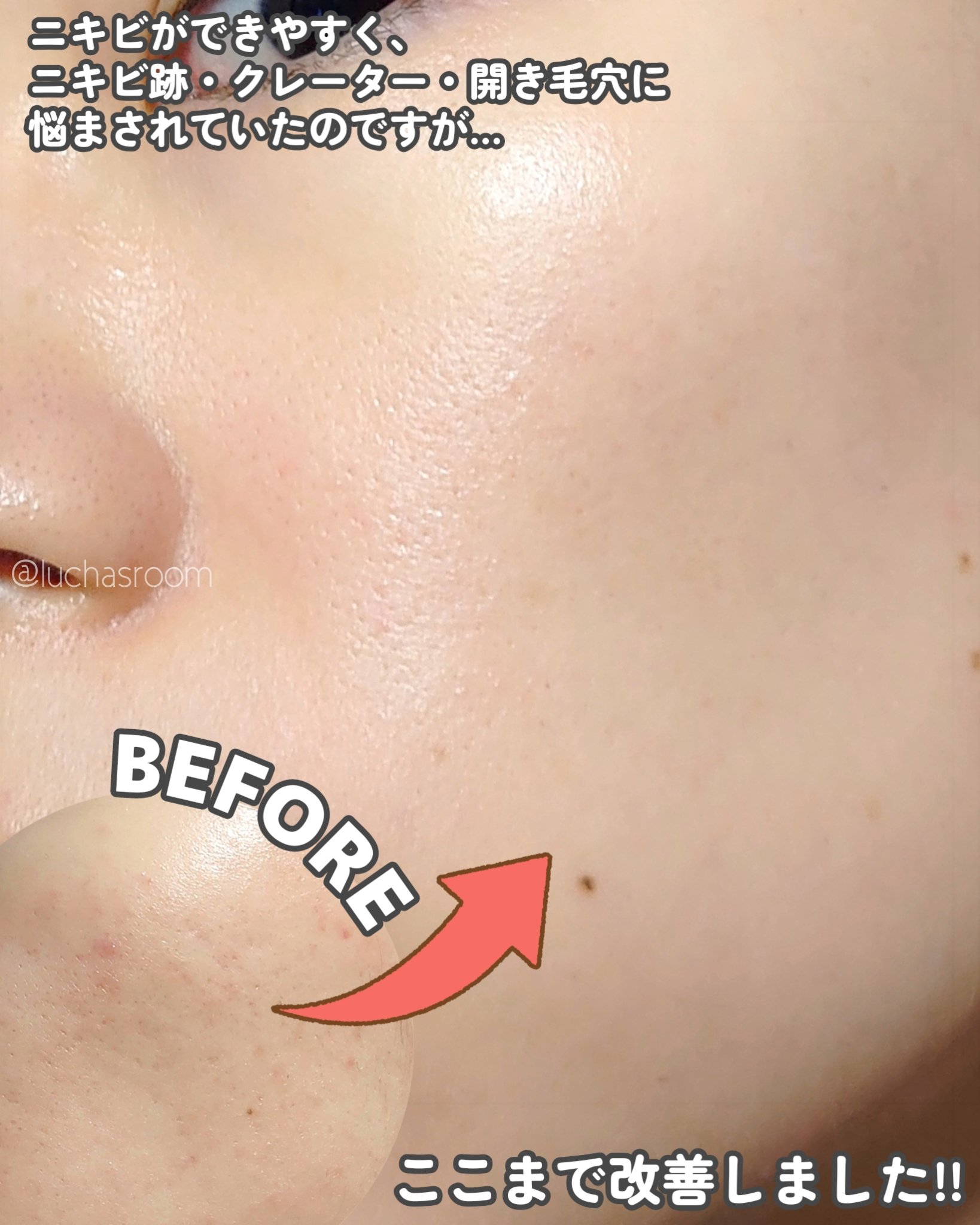 トリア・スキン エイジングケアレーザー/トリア/美顔器・マッサージを使ったクチコミ（2枚目）