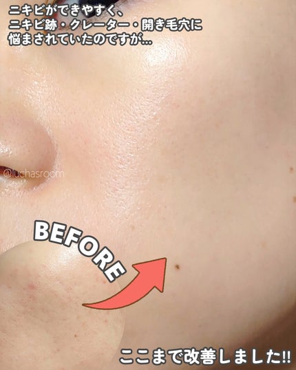 トリア・スキン エイジングケアレーザー/トリア/美顔器・マッサージを使ったクチコミ(2枚目)