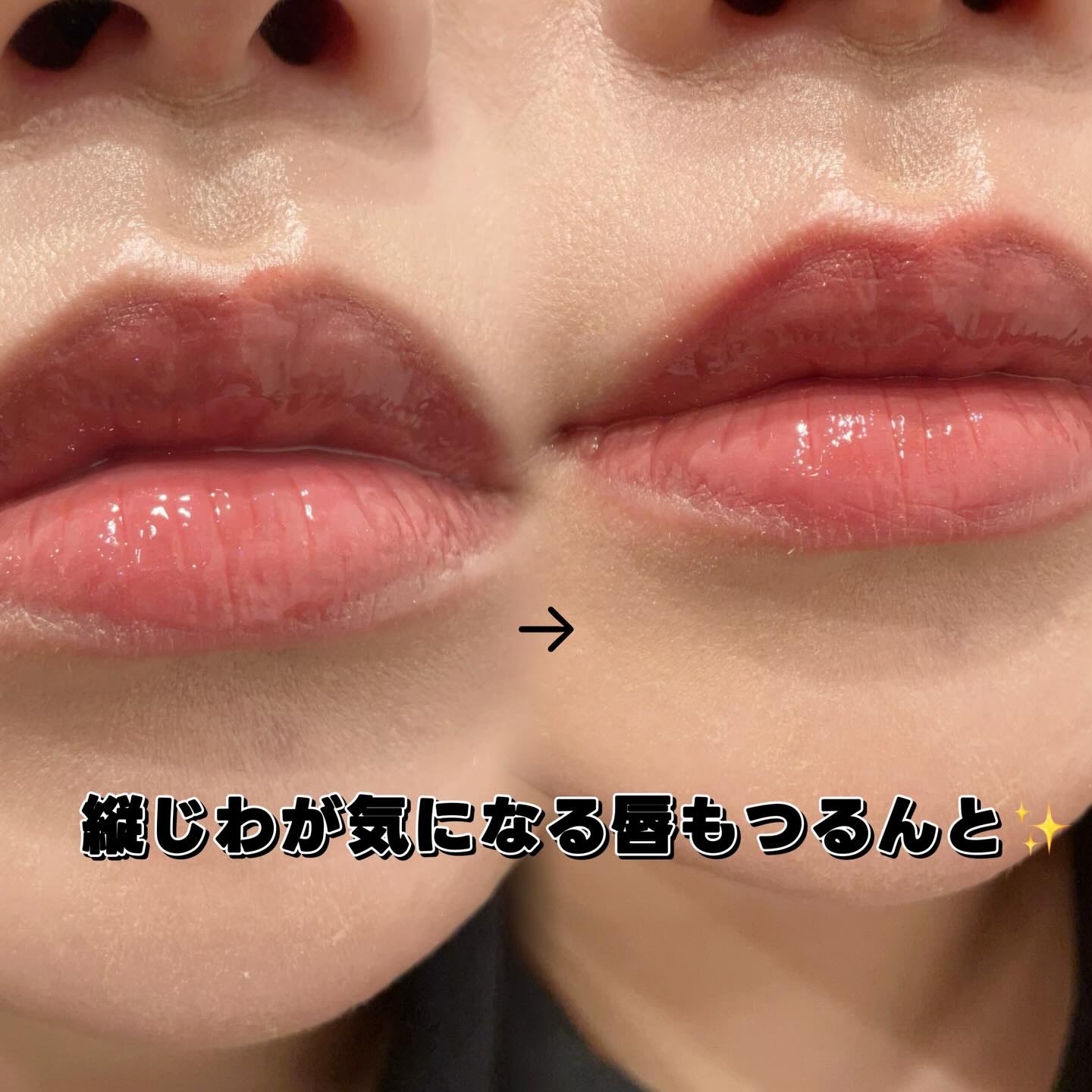 フレイムライトリッププランパー/LoNLy /リッププランパーを使ったクチコミ（3枚目）