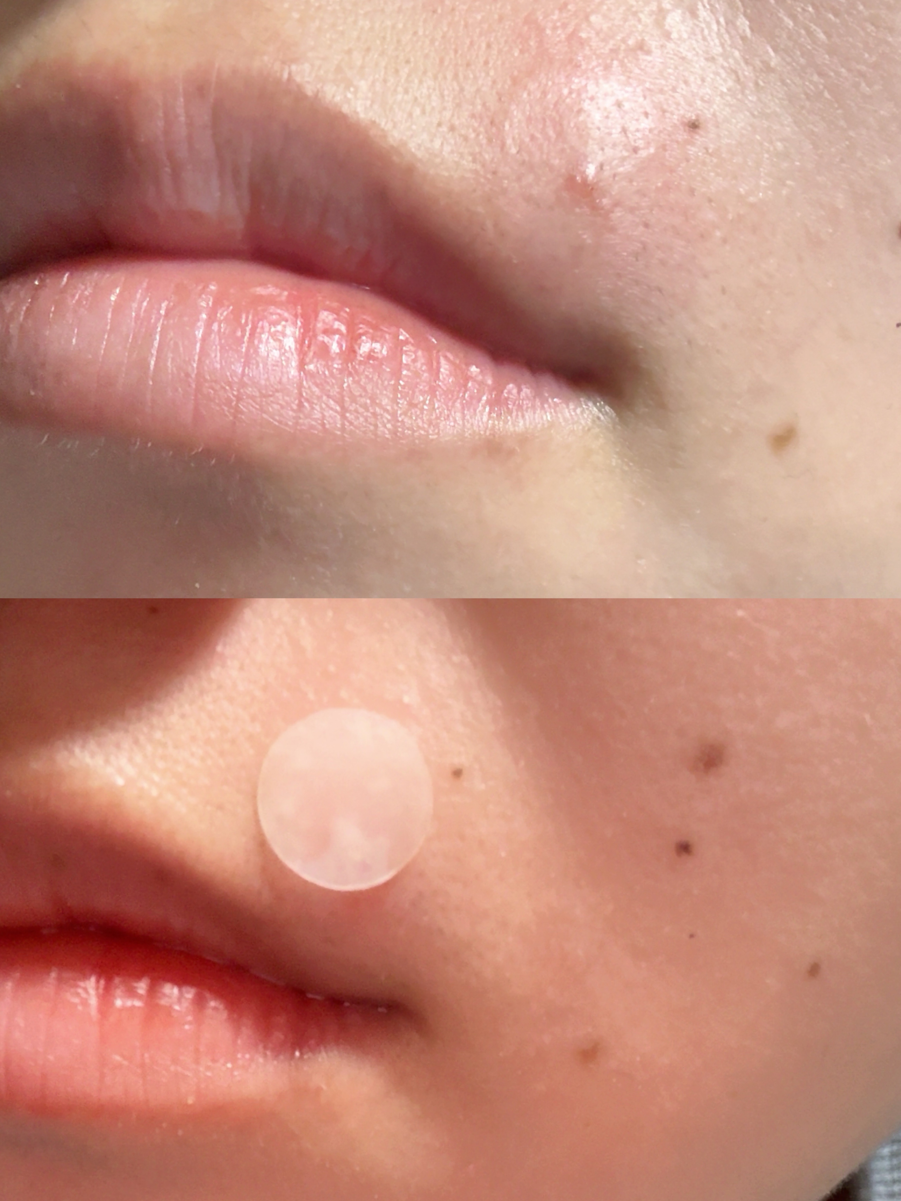 アクネピンプルマスターパッチ /COSRX/にきびパッチを使ったクチコミ（2枚目）