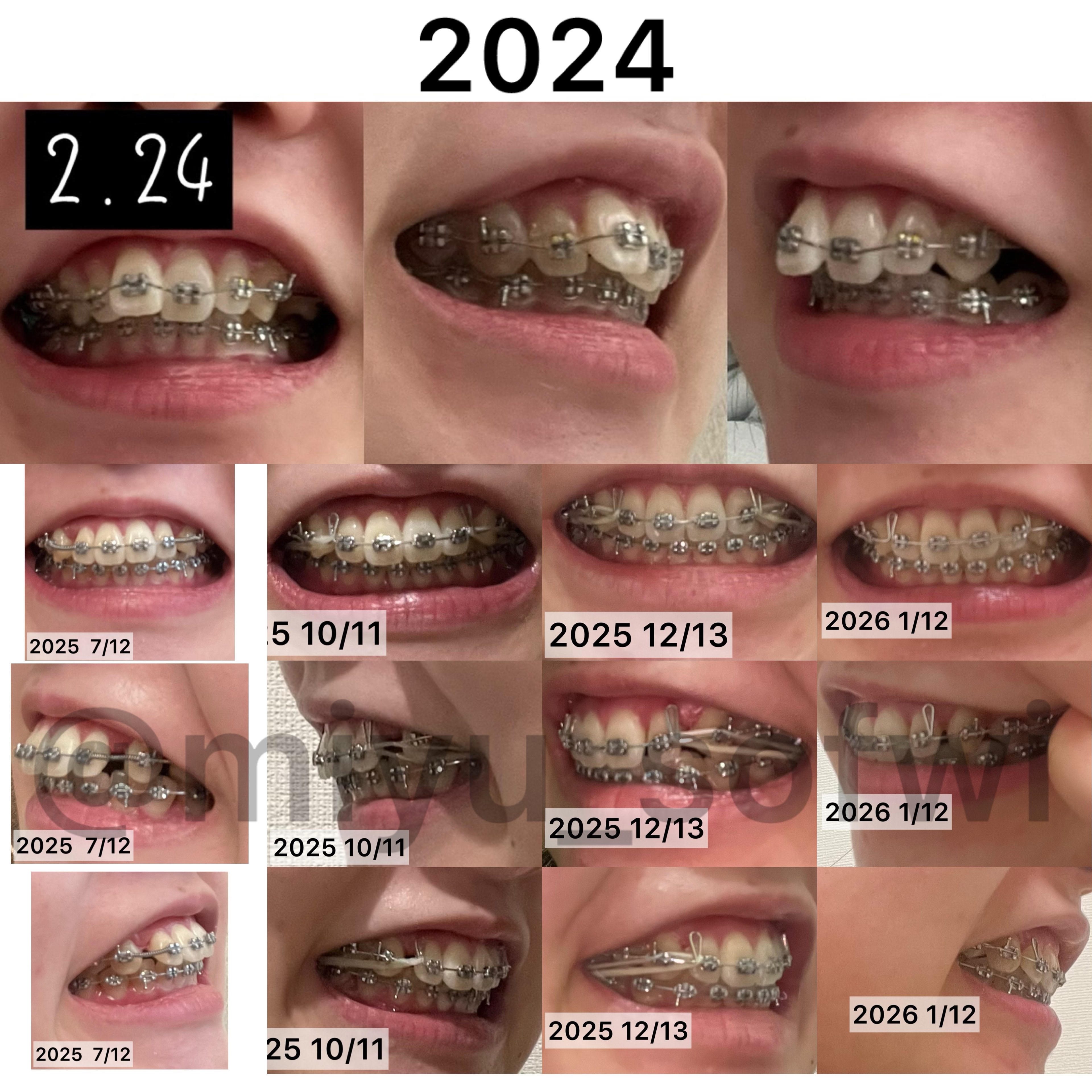 システマハブラシ/システマ/歯ブラシを使ったクチコミ（3枚目）