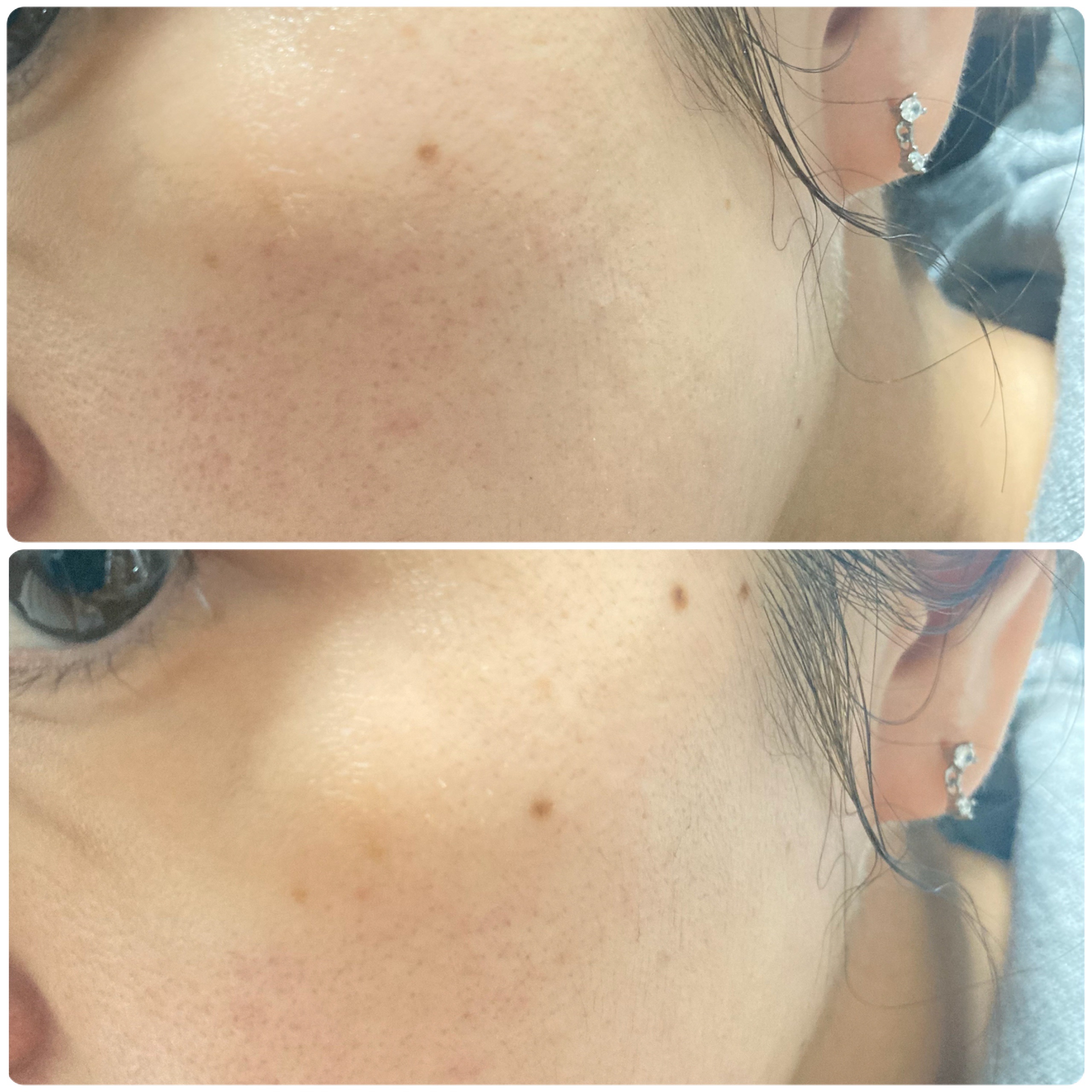 パーフェクトワン 薬用ホワイトニングセラム/パーフェクトワン/美容液を使ったクチコミ（3枚目）