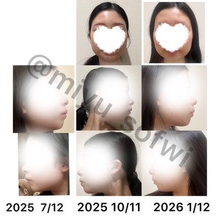 ガム歯周プロケア ソフトピック/GUM/デンタルフロス・歯間ブラシを使ったクチコミ(2枚目)