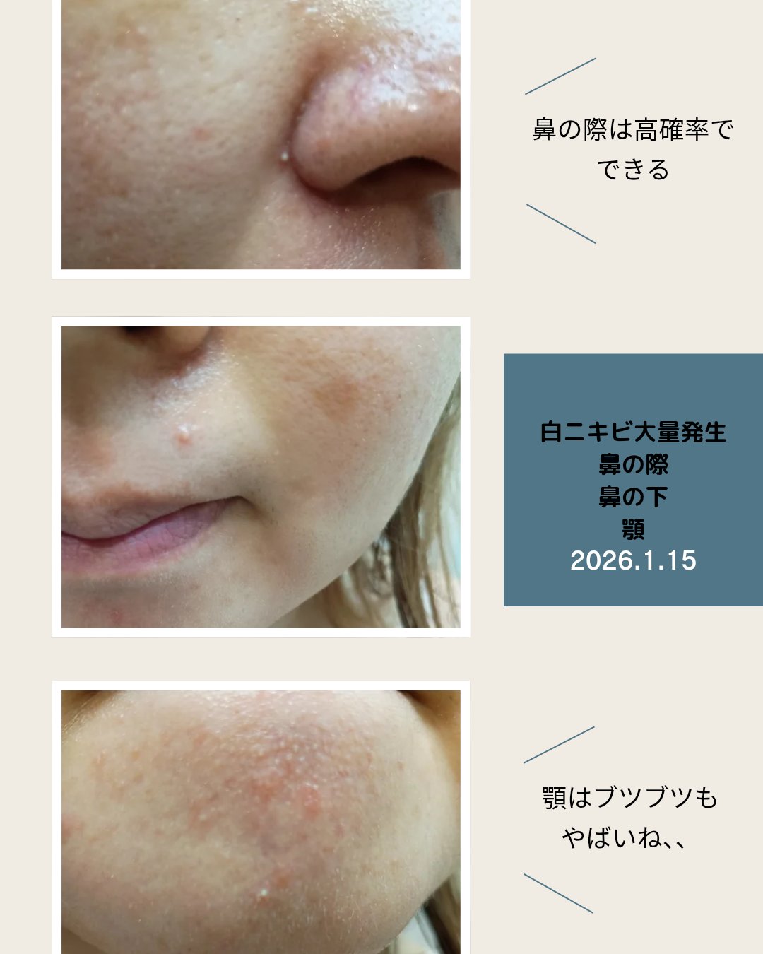 アンナザルベ・エース(医薬品)/エスエス製薬/その他を使ったクチコミ（2枚目）