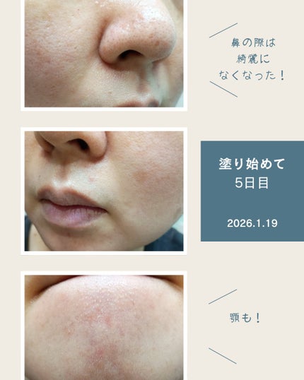 アンナザルベ・エース(医薬品)/エスエス製薬/その他を使ったクチコミ(3枚目)