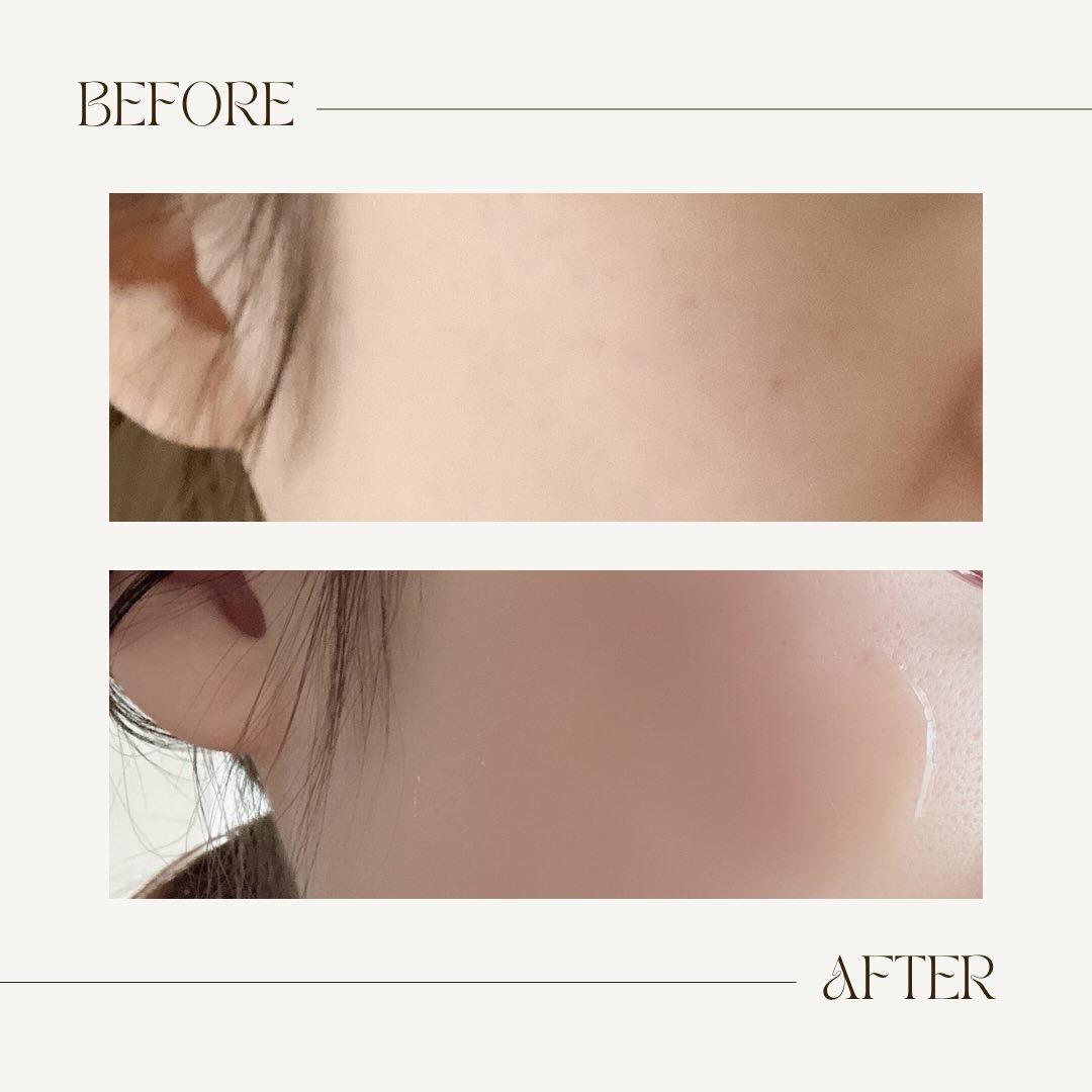 C×AZ ダーマインショット200/ESIENCE/美容液を使ったクチコミ（3枚目）