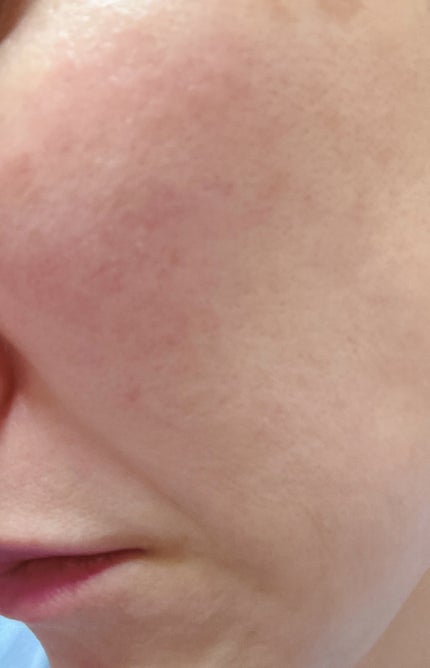 ダーメラ ルミショット・Wビタセラム/Dermela/美容液を使ったクチコミ(5枚目)