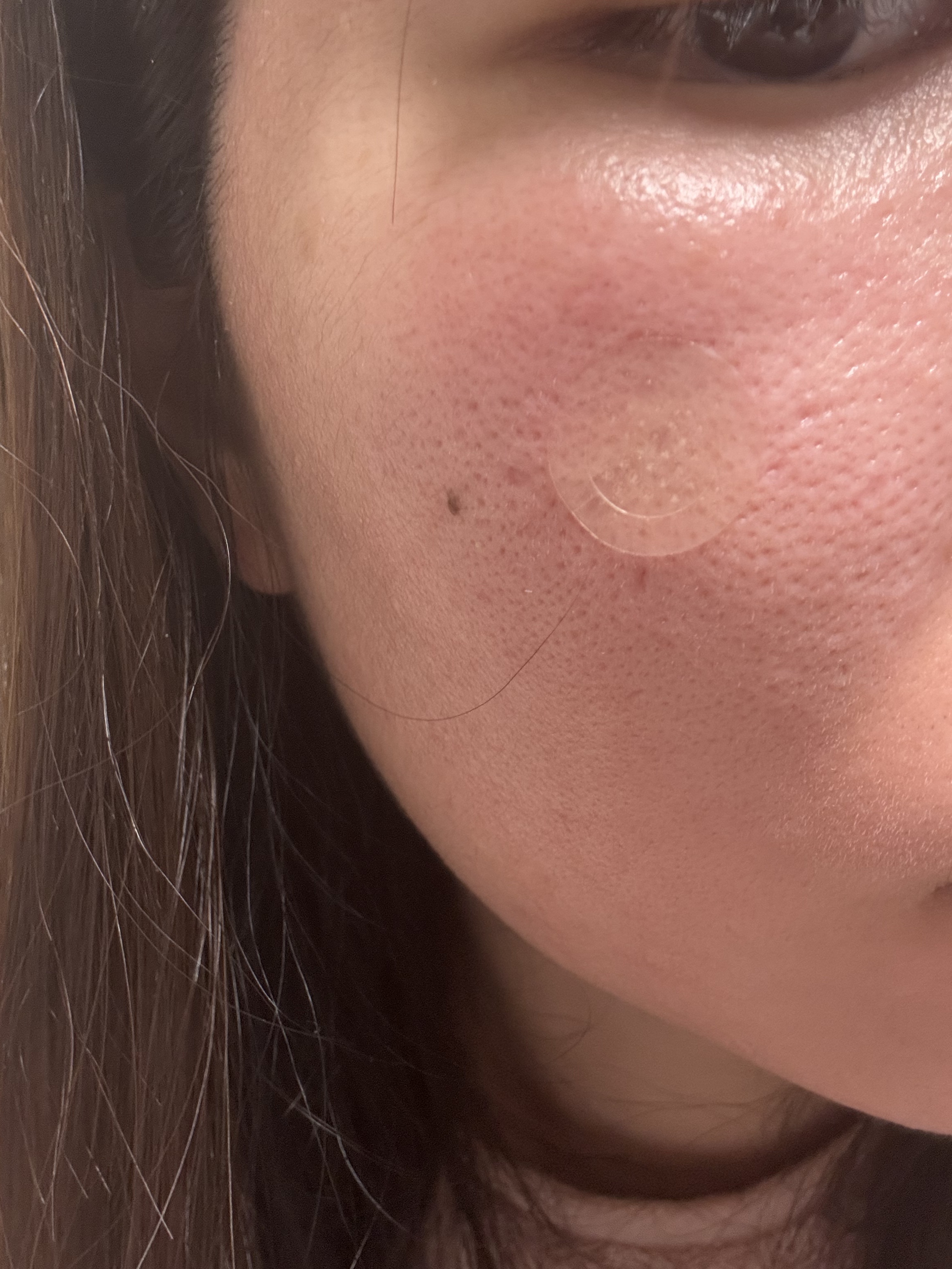 エイシーケアNE/ACROPASS/その他スキンケアを使ったクチコミ（2枚目）